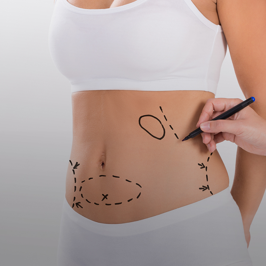 Chirurgie esthétique abdominoplastie Lyon, Bourg en bresse, Rhône, Ain