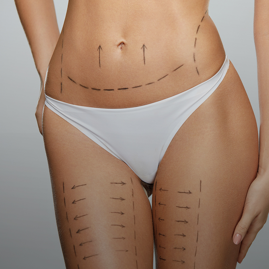 Chirurgie esthétique bodylift Lyon, Bourg en bresse, Rhône, Ain